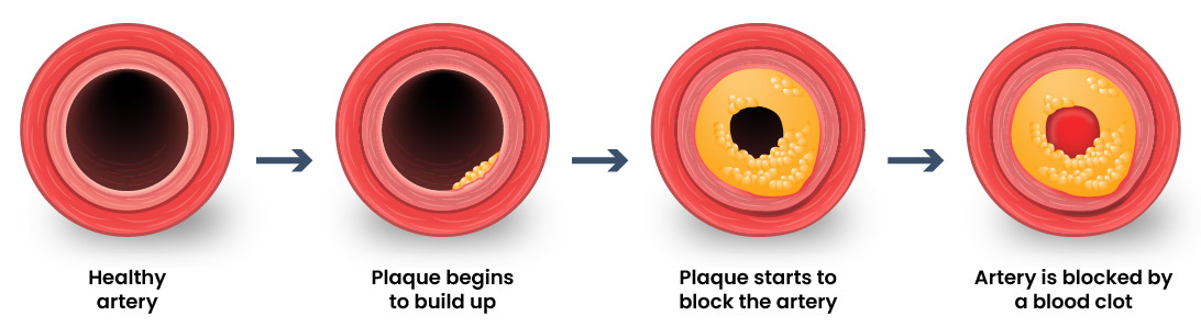 Cut section of artery showing four stages of plaque build-up. From the left to the right, the stages are: healthy artery, plaque begins to build up, plaque starts to block the artery, and artery is blocked by a blood clot.