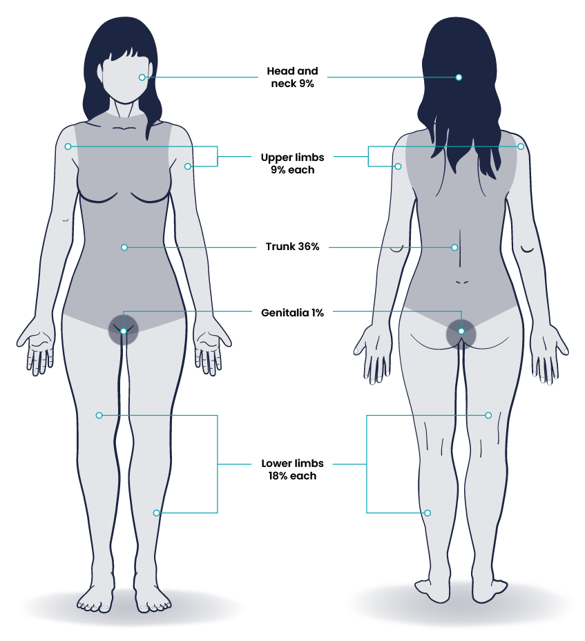 Diagram showing the front and back of a woman’s body with five labels. Each label points to a section of the body. From top to bottom, the labels read: head and neck 9%, upper limbs 9% each, trunk 36%, genitalia 1%, and lower limbs 18% each.