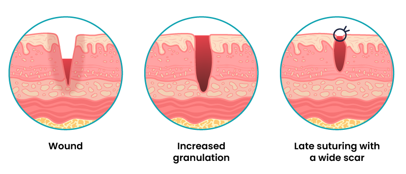 Diagram showing three stages of wound healing placed in circles arranged in a row. The first circle shows the wound in the initial stages of healing. The second circle shows increased granulation. The wound in this circle is deeper. The third and final circle shows a slightly healed wound with a suture closing the skin. Under this circle is a label: Late suturing with wide scar.