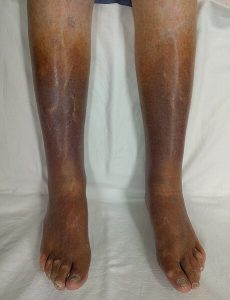 Photo of a person’s legs. From the shins to the toes, the skin colour ranges in darker colours indicating chronic venous insufficiency.