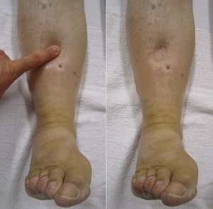 A before and after photo of a person pressing down on a person’s swollen leg. The photo on the left shows where the person is pressing down on the shin. On the right, the person has removed their hand, yet an indent of their finger remains.