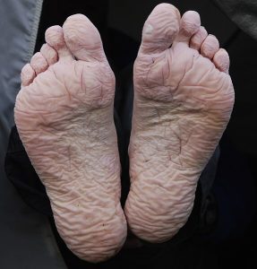 Photo a person’s feet. The souls of the feet are wrinkled, indicating trench foot damage or macerated skin.