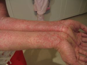 Eczema on the inside of a person’s forearms. The person’s skin has red blotches.