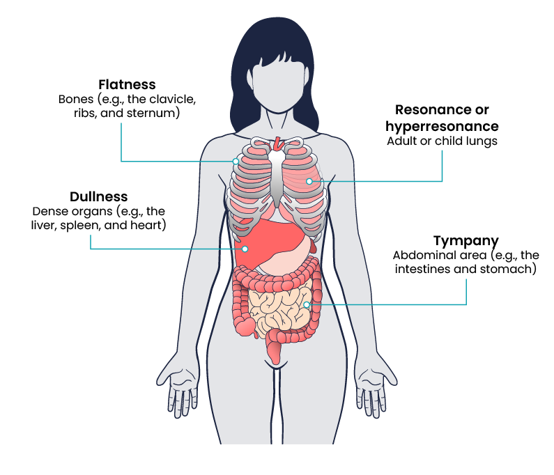 Diagram showing from a woman’s body from her thighs up to her head. The diagram shows ribs and organs in the woman’s torso, including the lungs, heart, liver, spleen, stomach, and intestines. Four labels point to the body. The top left label points to the ribs and reads: Flatness – Bones (e.g., the clavicle, ribs, and sternum). The top right label points between a gap in the ribs to the lung and reads: Resonance or hyperresonance – Adult or child lungs. The bottom left label points to the liver and reads: Dullness – Dense organs (e.g., the liver, spleen, and heart). Finally, the bottom right label points to the intestines and reads: Tympany – Abdominal area (e.g., the intestines and stomach).