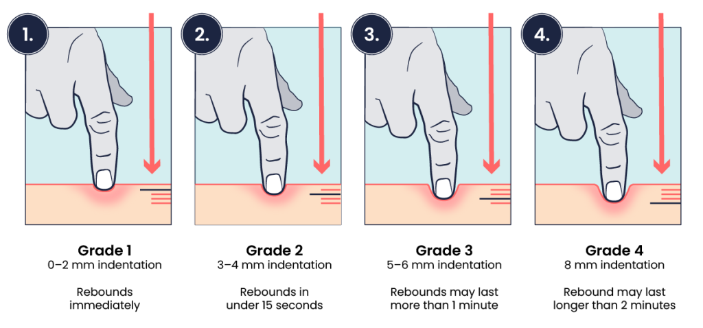 A row of four graphics with text underneath. Each of the four graphics shows a finger pushing down on skin that is consistently more indented. From left to right, the text reads: Grade 1. 0–2 mm indentation rebounds immediately. Grade 2. 3–4 mm indentation rebounds in under 15 seconds. Grade 3. 5–6 mm indentation rebounds may last more than 1 minute. Grade 4. 8 mm indentation rebound may last longer than 2 minutes.