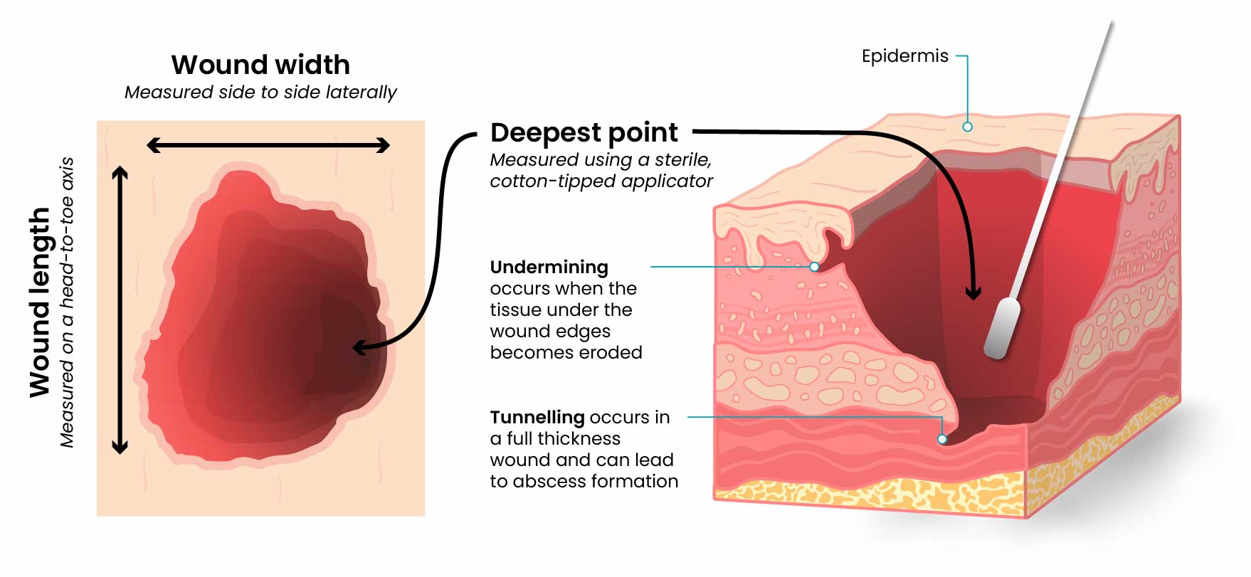 Surface and cross-section of a wound with labels indicating how to measure the wound. The surface shot of the wound (left) shows how the width is measured from side to side laterally, the length is measured on a head-to-toe axis, and the deepest point is measured using a sterile applicator. The cross-section (right) shows how tunnelling can occur towards the bottom of a full thickness wound and can lead to abscess formation. The cut section also shows an example of undermining, which occurs when the tissue under the wound edges becomes eroded.