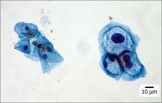 uterine cervix cells in an image slide, viewed through a light microscope, obtained from a Pap smear. Normal cells are on the left. The cells on the right are shown infected with human papillomavirus.