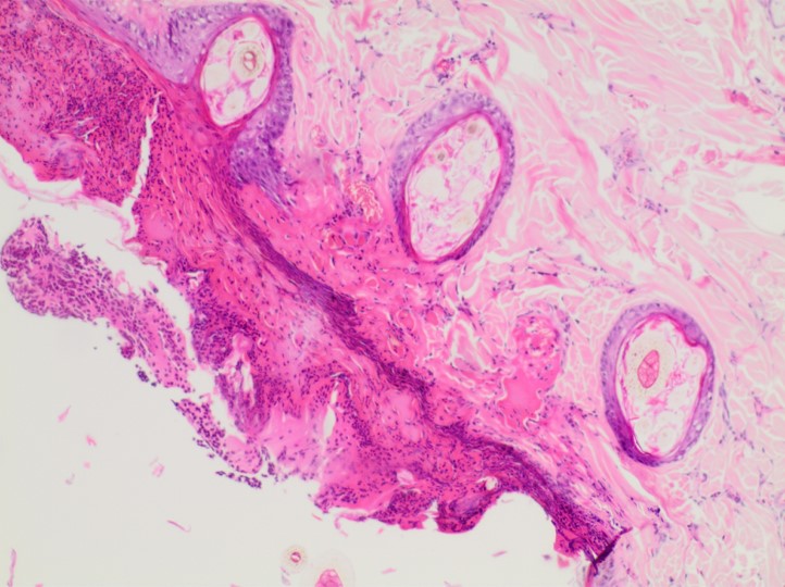 H&E stain of a dogs skin suffering from staphylococcal skin infections