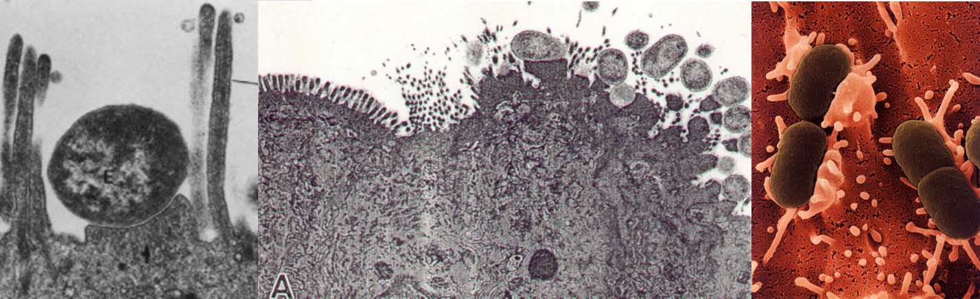 Attaching and effacing E. coli causing pedestal formation on the intestinal cells. Note that these pedestals prevent E. coli from being dislodged from the cell surface. However, due to loss of the brush border and thinkening of the cell membrane, fluid and nutrient absorption is decreased.