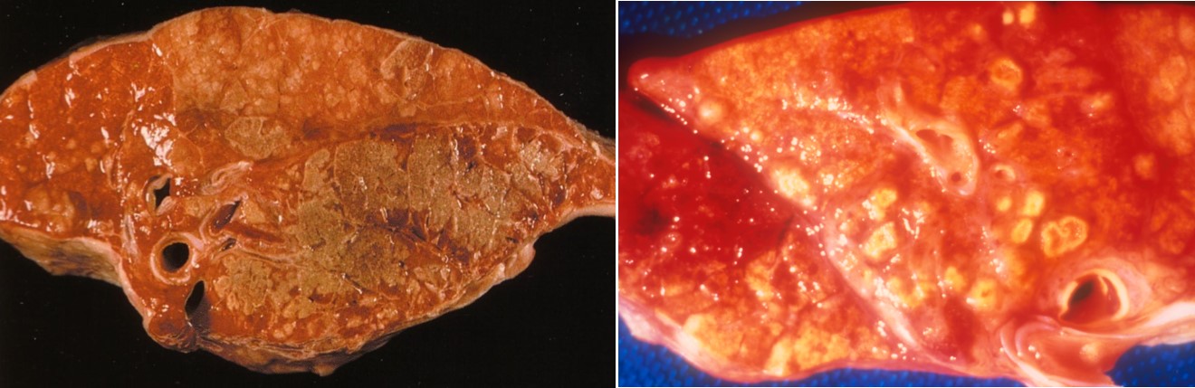 Cut section of chronic porcine pleuropneumonia lesions, showing the areas of coagulative necrosis and sequestra. This gives the lung a firm appearance and these lesions are often raised
