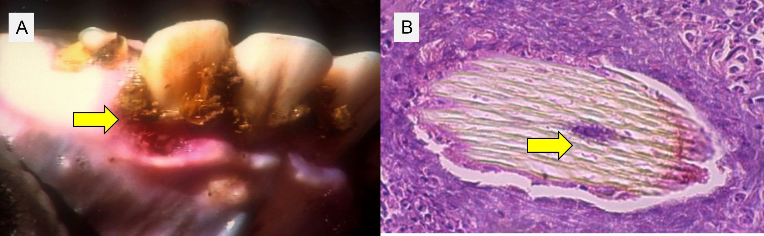 Bacteria entering via the oral cavity