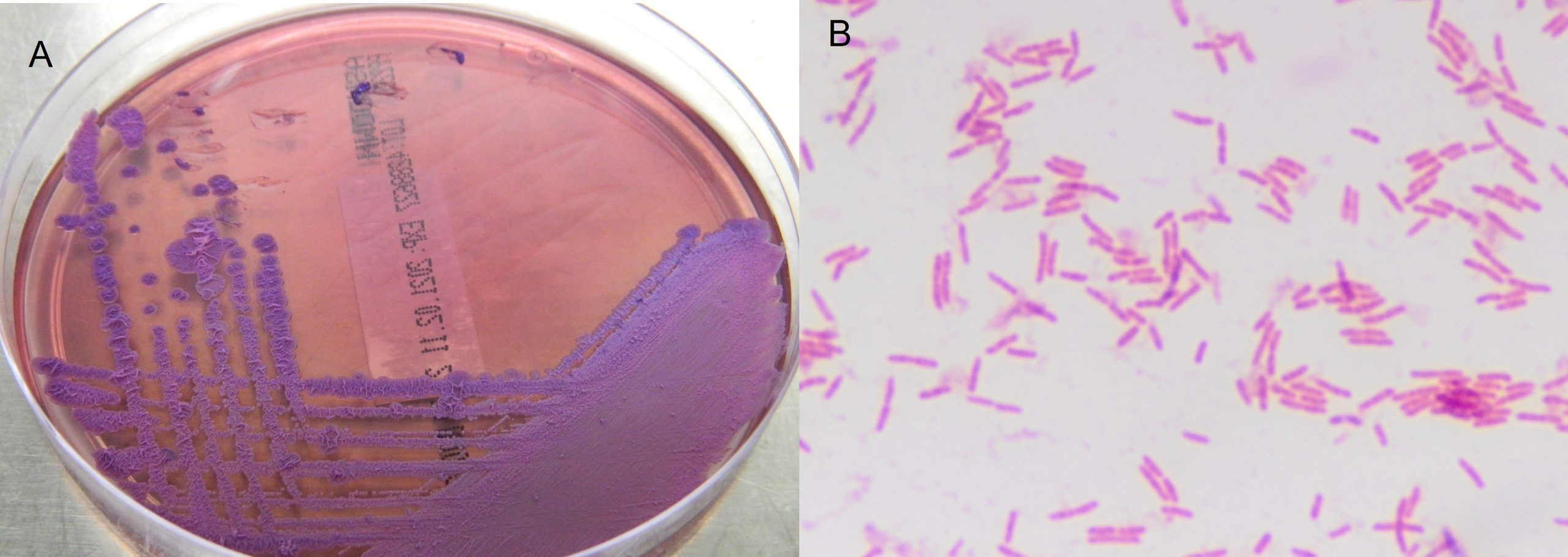 Growth of Burkholderia pseudomallei on the selective Ashdowns' medium in Picture A. Picture B is the Gram's stain of B. pseudomallei from the cultures.