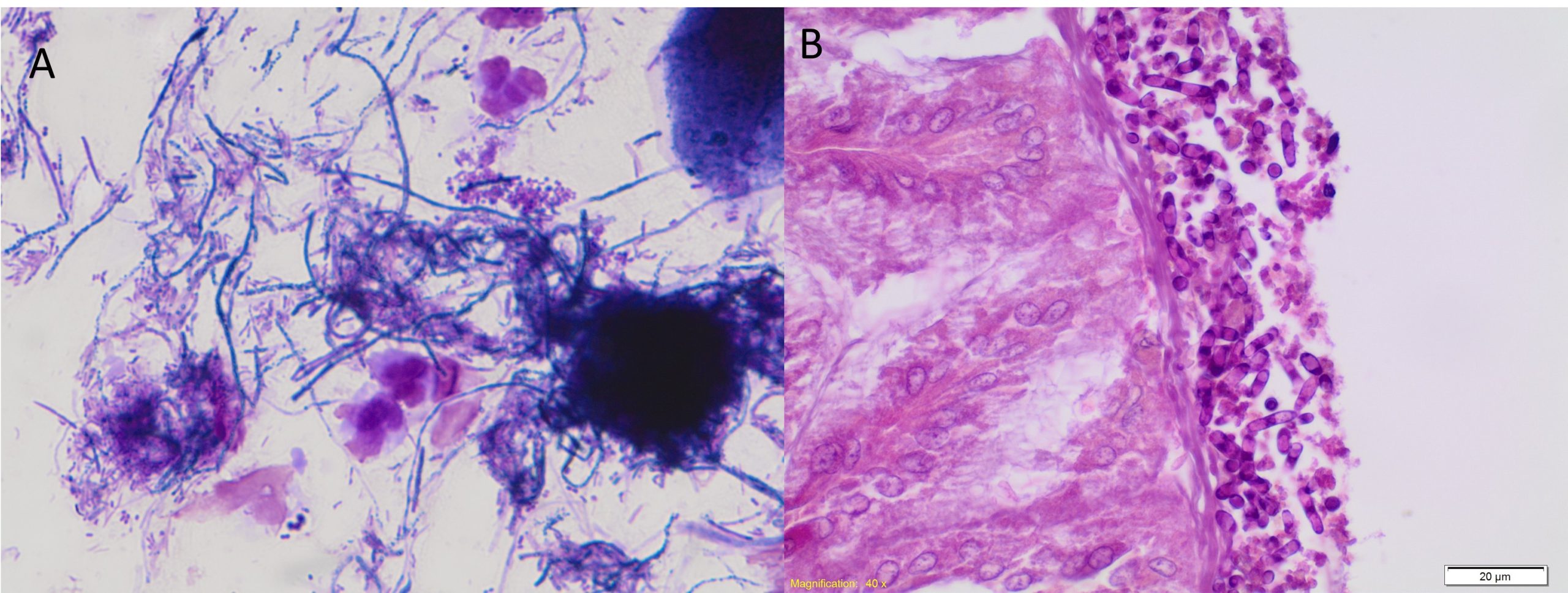 Candida infecting superficial structures. A: Hyphal forms of Candida cuasing an oral infection also called thrush. B: Candida infection of the superficial stomach of a koala. In this case the Candida has produced pseudohyphae