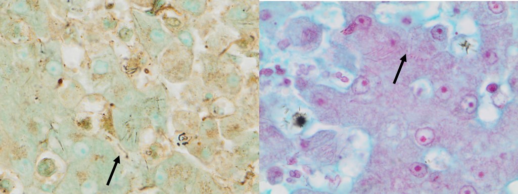 Tyzzer's disease in the liver of a neonatal kitten. Notice the very fine silver-stain positive rods in the left picture and fine Gram-negative rods in the right picture