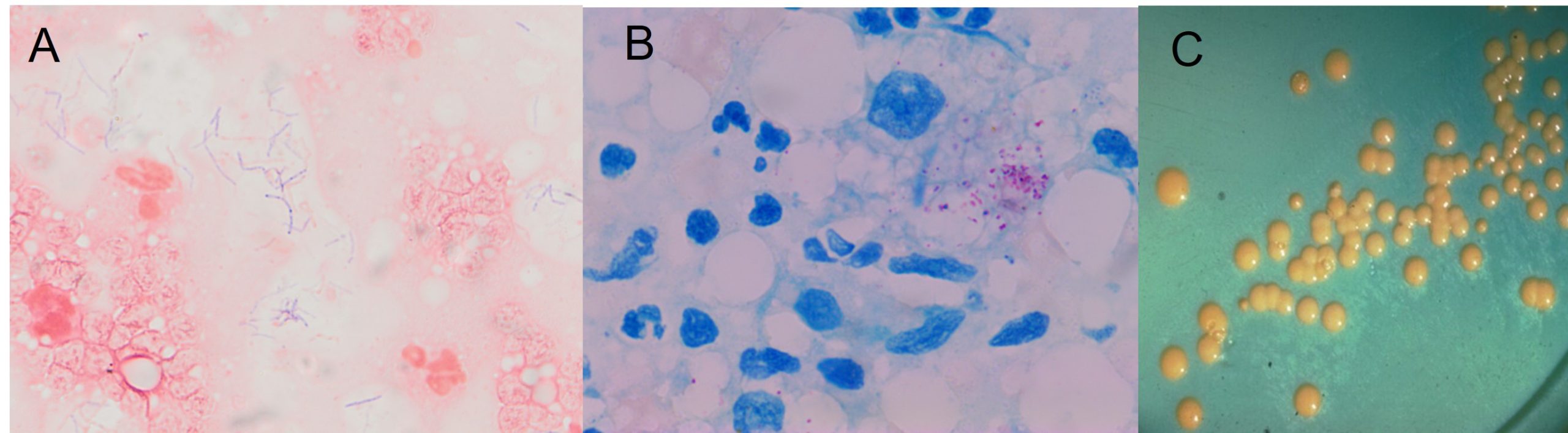 A case of bovine tuberculosis of the lung. Picture A: Gram's stain of an impression smear. Note the beaded , thin Gram positive rods. Picture B: Zieho-Neelsen stain of an impression smear. Note the pink acid fast rods. Picture C: 8 week old culture of M. bovis on Mycobacterium growth agar showing small yellow colonies.