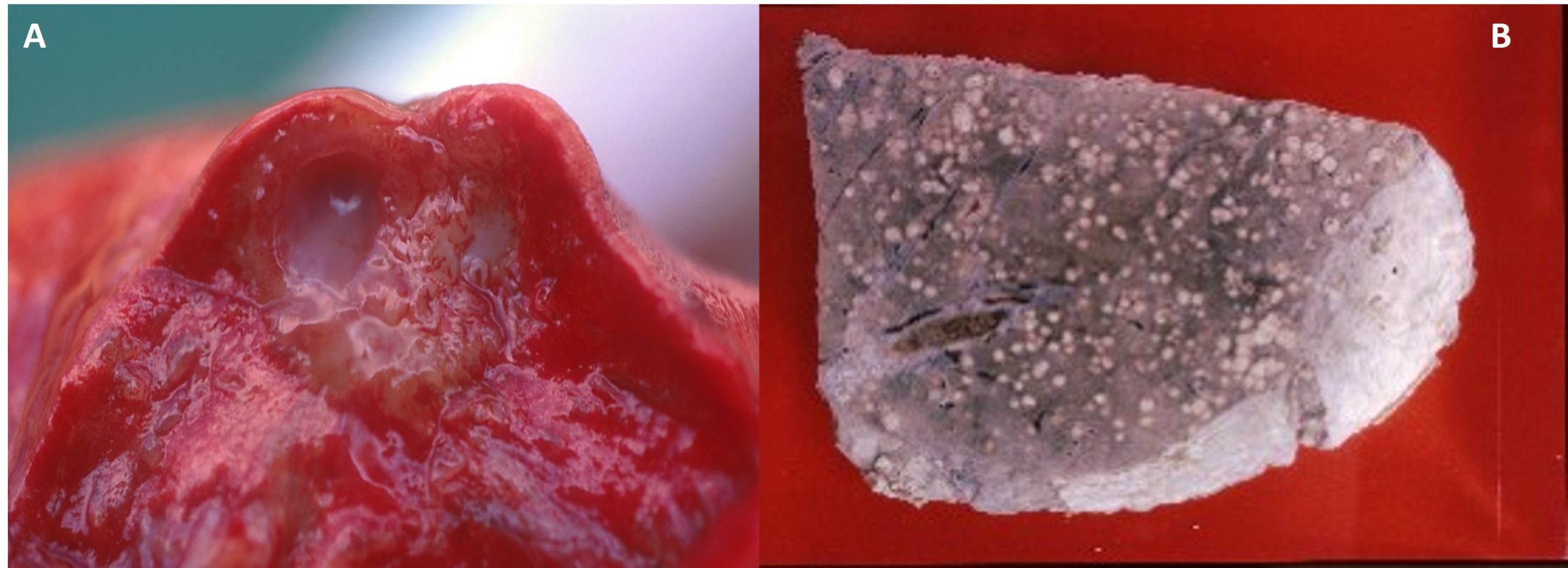The TH2 in picture A and the Th1 response with heamtogenous dissemination to the liver is shown in Picture 2.