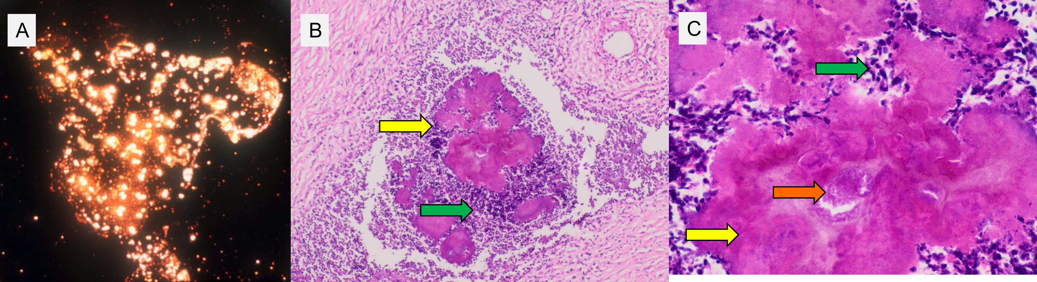 Splendore-Hoeppli phenomenon in tissue