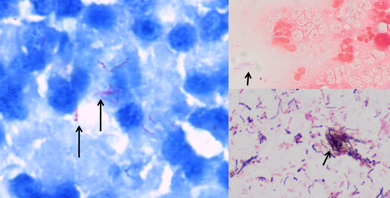 Staining characteristics of Mycobacterium Left: Ziehl-Neelsen stain (acid-fast) showing pink bacteria; Right: Gram-positive beaded rods typical of mycobacteria.