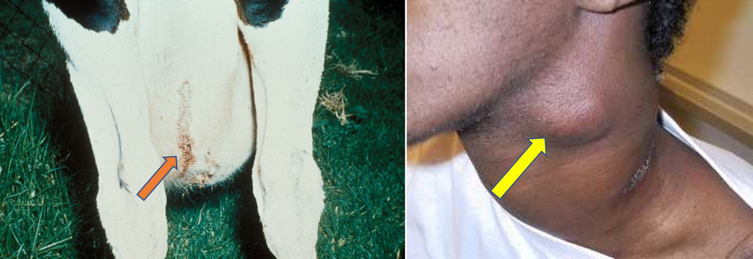 Left picture: Bovine tuberculosis of the mammary gland of a cow. Right picture" Superficial lymph node enlargement in a person infected with M. bovis after drinking infected milk.