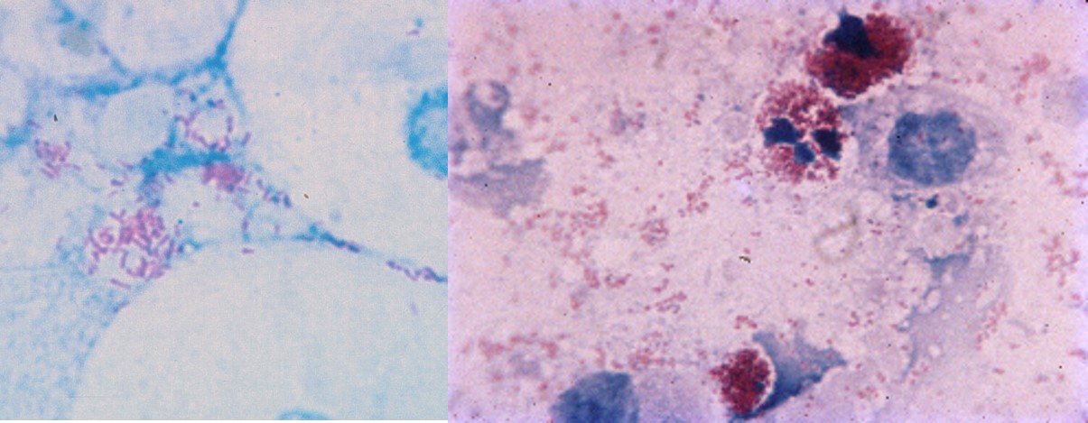 Brucella species staining positive (red) with the modified acid-fast stain. Note the intracellular cocci. Coxiella tends to forms short partially acid-fast intracellular rods.