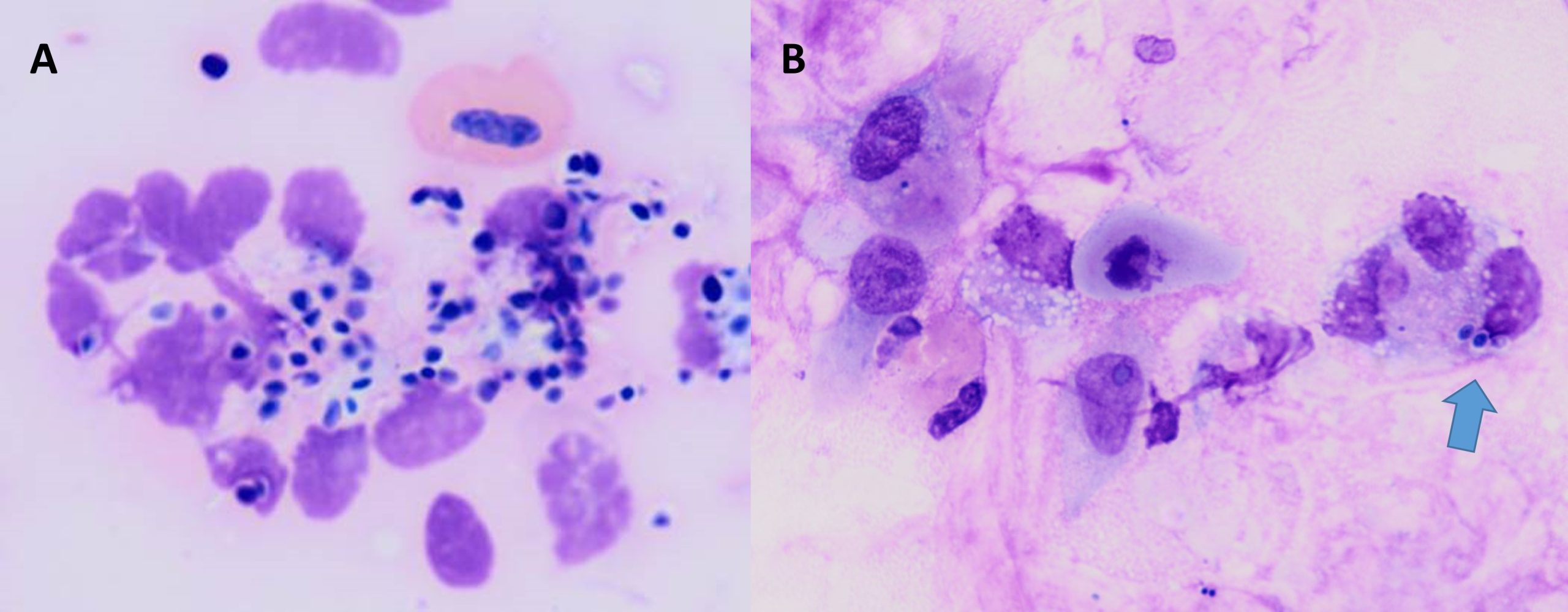 Candida species superficial infections. DiffQuik staining A:Eear exudate from a dog suffering from chronic otitis externa. B: Crop smear from a young bird that is failing to thrive