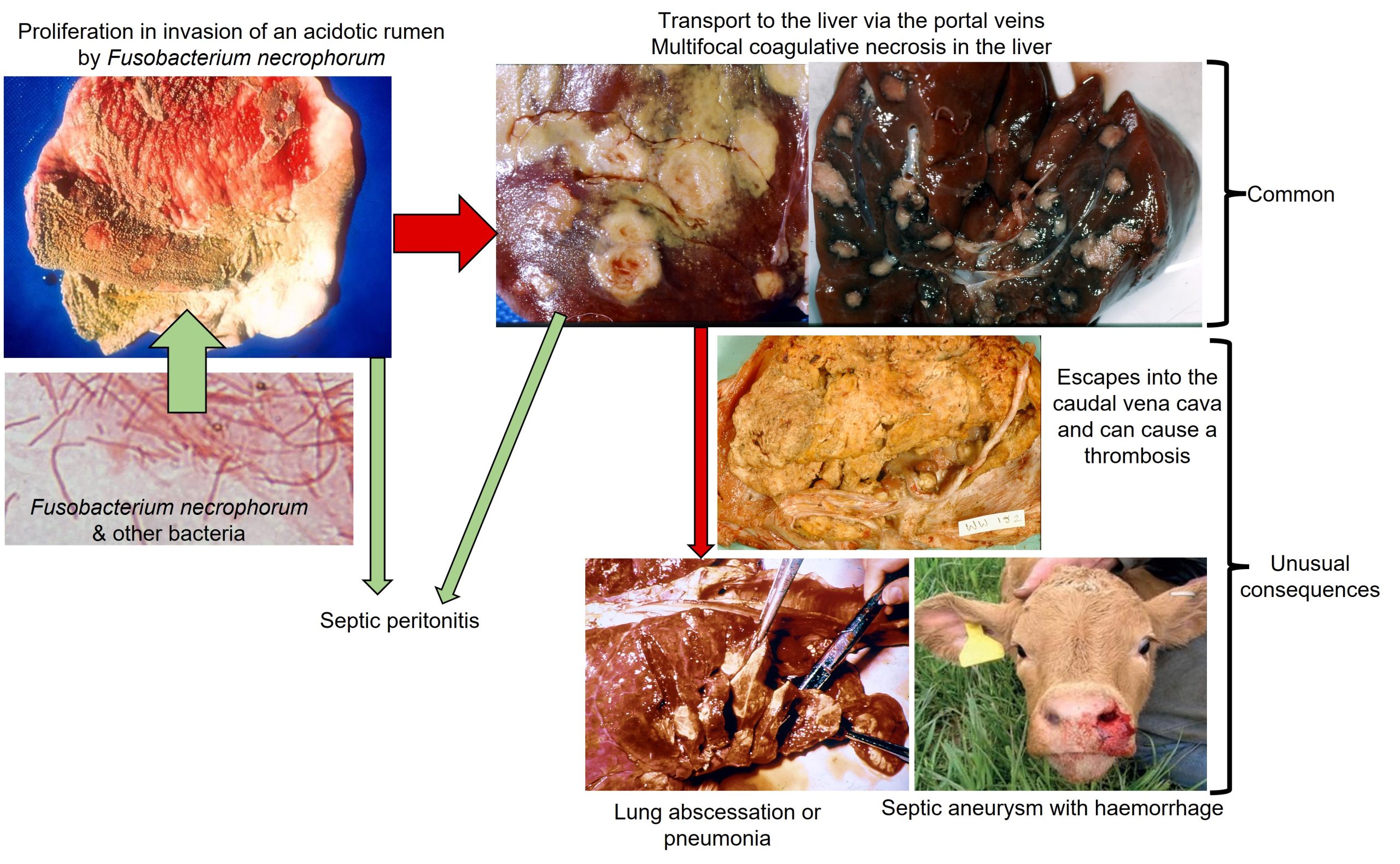 Acidosis with its consequences when Fusobacterium necrophorum is allowed to proliferate. This includes liver abscessation, the most common event and less commonly embolisms of the caudal vena cava and pulmonary blood vessels. Pneumonia and a septic aneurysm may occur. The bacterium may extend into the abodomen either via the damaged rumen or via the liver causing a peritonitis.