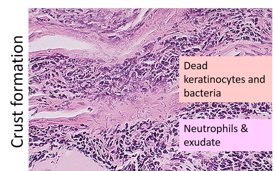 H&E staining of a transverse section of skin infected with D. congolensis