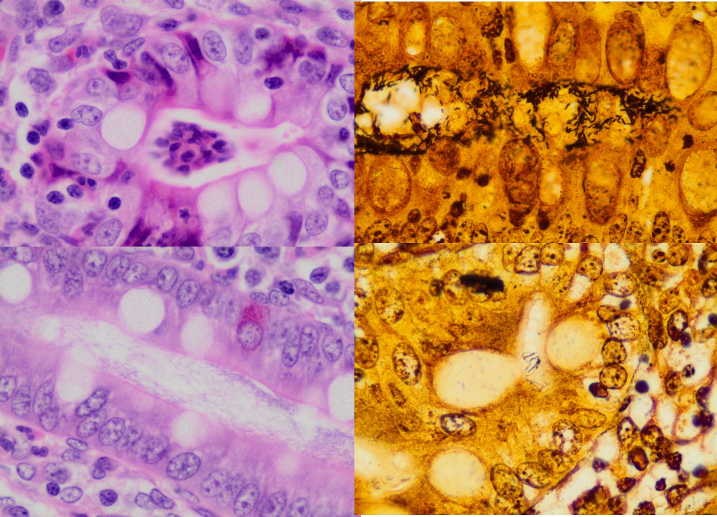 Histopathology: Intestinal hyperplasia and increased goblet cells are noted in the H&E stains on the left of the large intestine. On the right the silver stain shows up the very fine thread-like spirochaete, Brachyspira within the intestinal crypts.