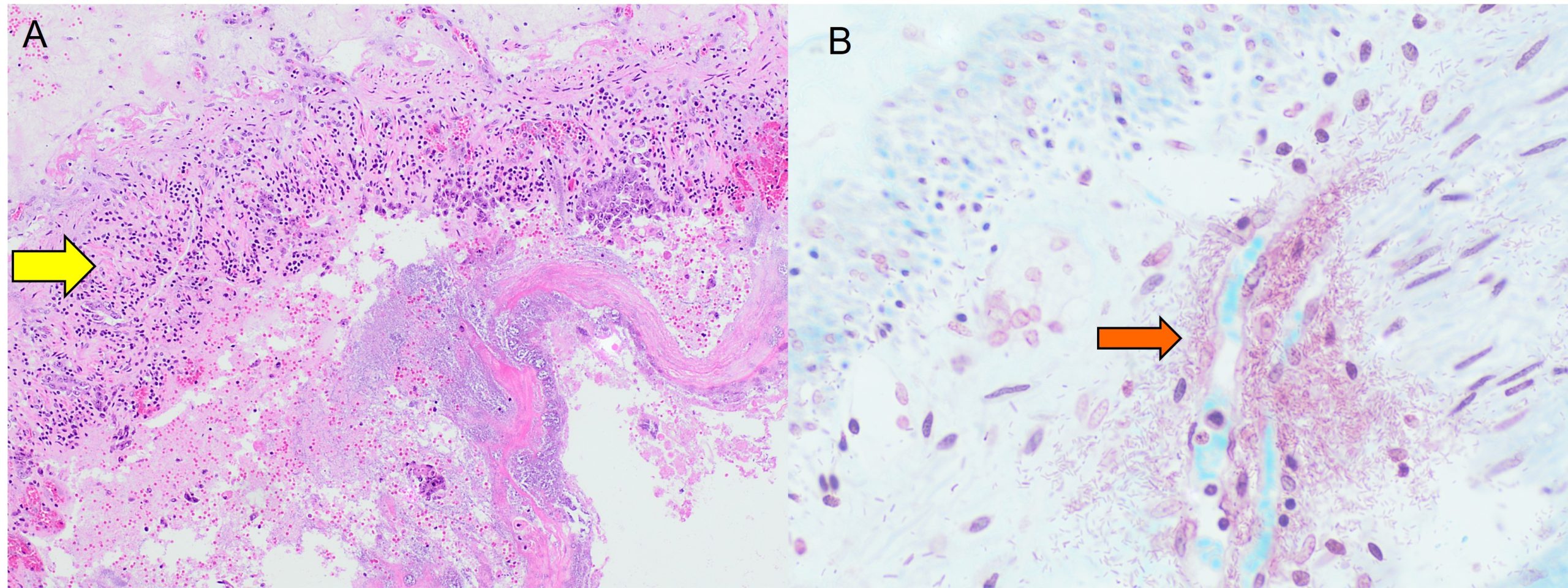 Intestinal infection of a wallabies intestinal epithelium. PIcture A: H&E stain causing necrosis and slough (yellow arrow). In Picture B which is a Grams stain of the same site, Gram negative bacteria (orange arrow)are present in high numbers in the submucosa
