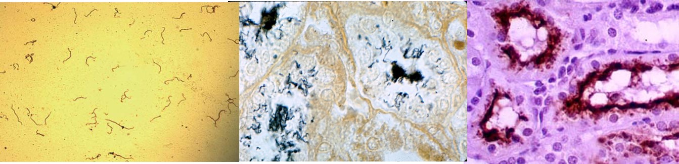 The presence of leptospires on dark field microscopy in the urine andin stained sections of proximal tubules of the kidney: silver staining in the middle picture and antigen specific immunoperoxidase test on the right.