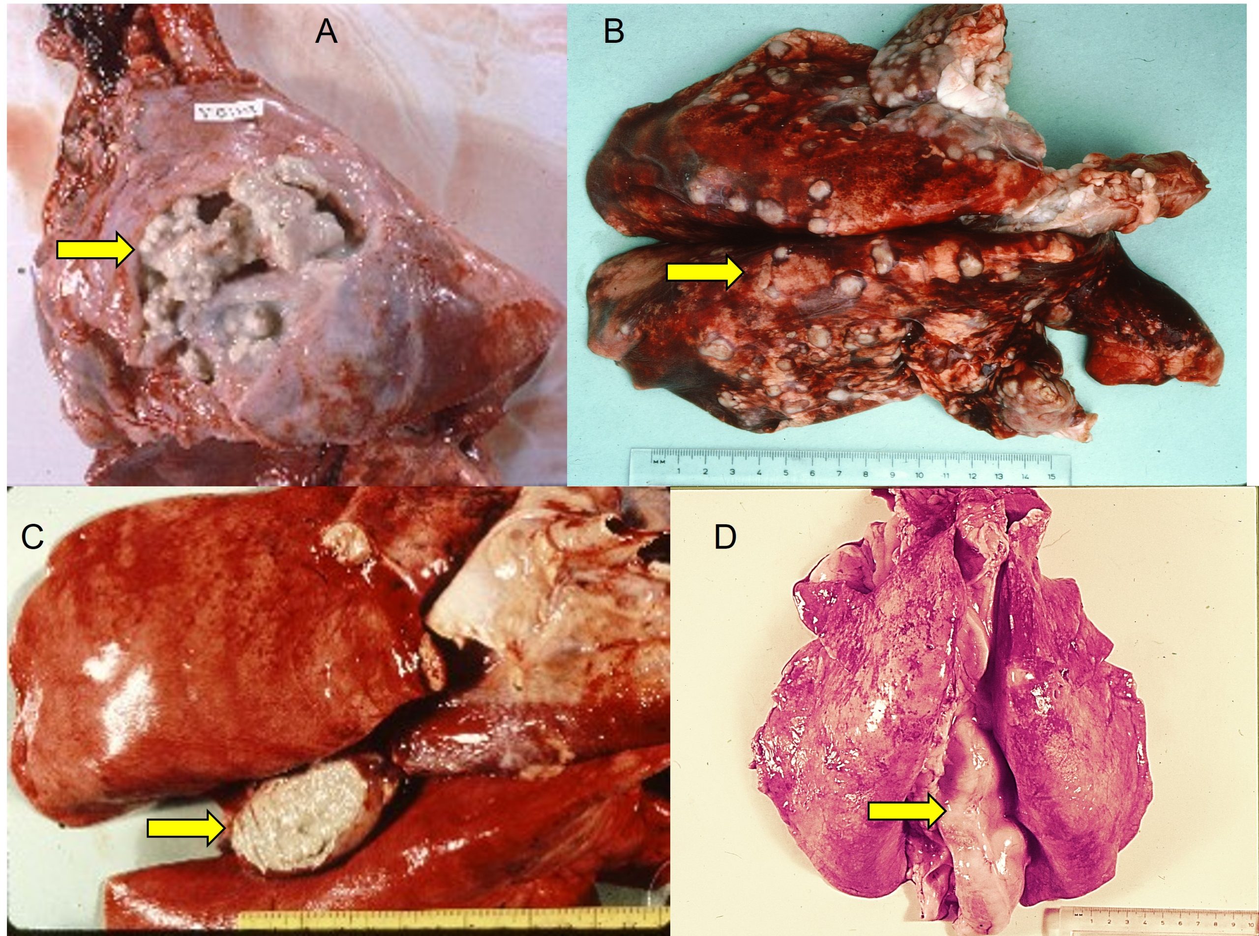 lung lesions CLA