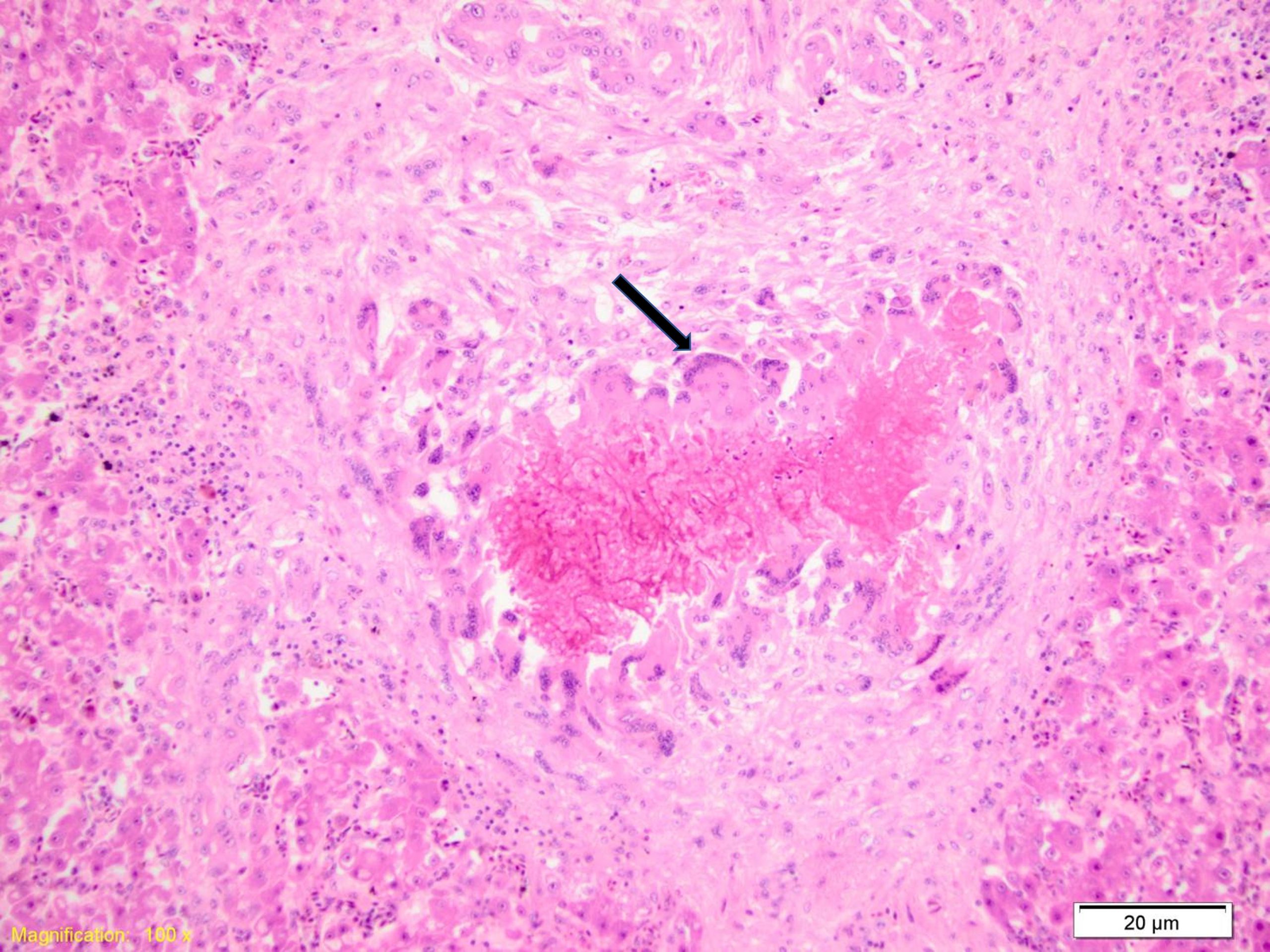 Granulomas within the liver of a koala that died. The central area of coagulative necrosis is surrounded by multinuceated giant cells (black arrow).
