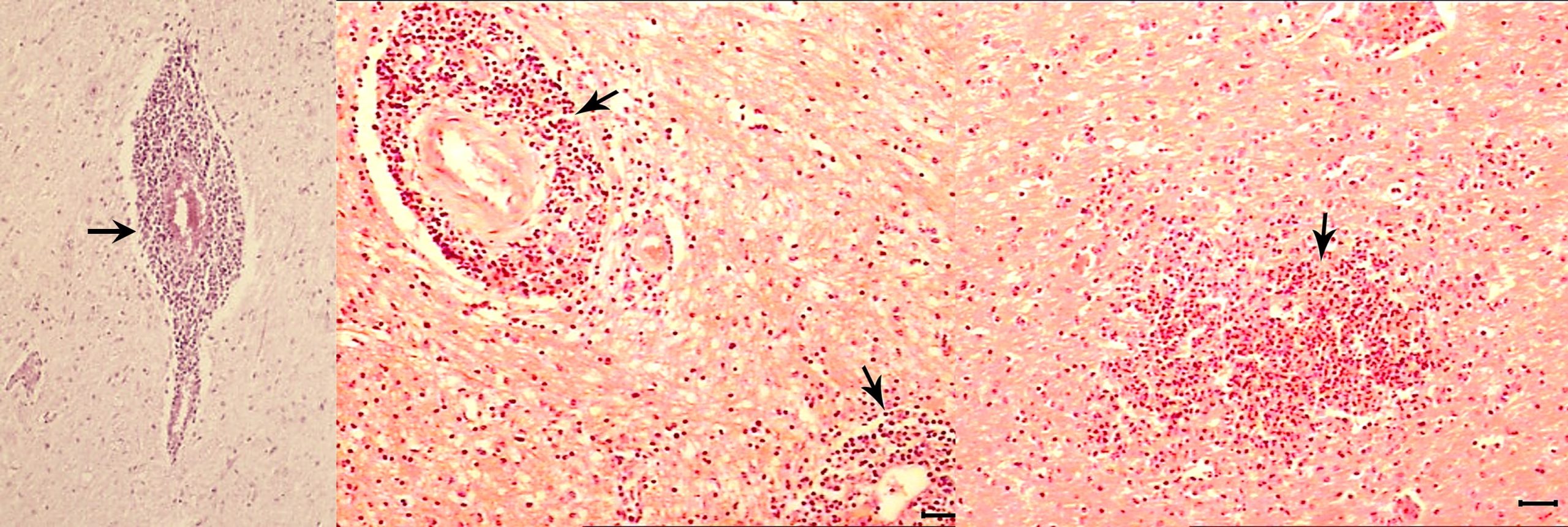 Histology with H&E stains of inflammation and microsbscesses within the brainstem of a sheep that had died from neurolisteriosis.