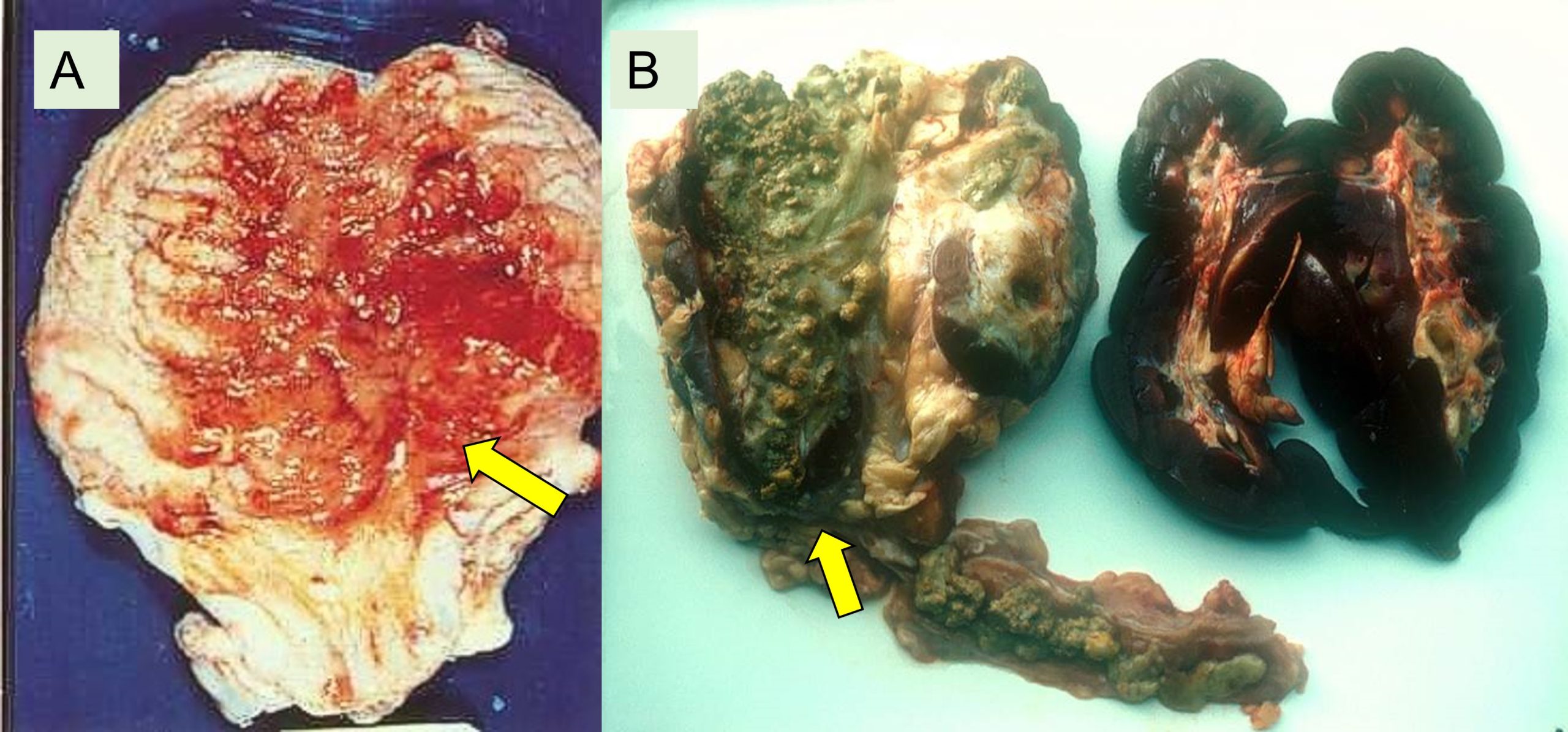Cystitis and pyelonephritis in cows