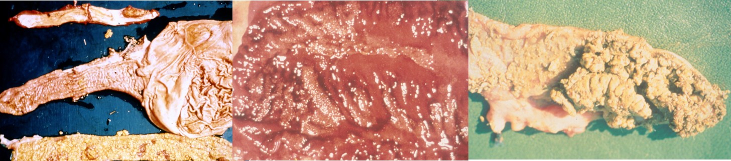Pathology of swine dysentery, showing proliferation in the intestinal mucosa, swelling and thickening of the intestinal mucosa and in the left and right pictures the preence of a diptheritic membrane.