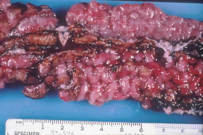 Proliferation and necrosis of the ileum of a growing pig caused by infection with Lawsonia interacellulare. Its invasion of intestinal cells is aided by the normal intestinal microflora