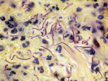 Filamentous form of Bacillus anthracis in a lymph node