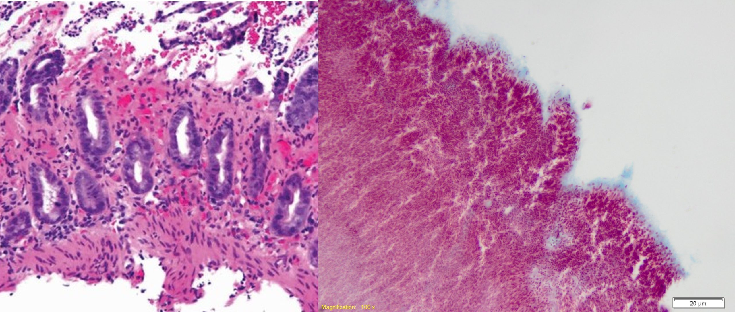 intestinal disruption caused by Escherichia coli shigatoxin