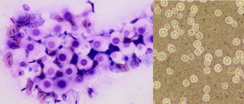 The thick capsule of Cryptococcus noted in a DiffQuik stain (left picture) and in a permanent ink stain (right)