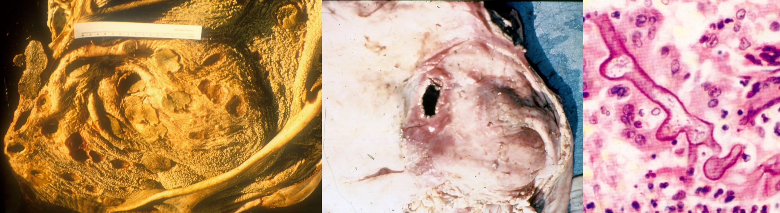 muoromycosis of the rumen