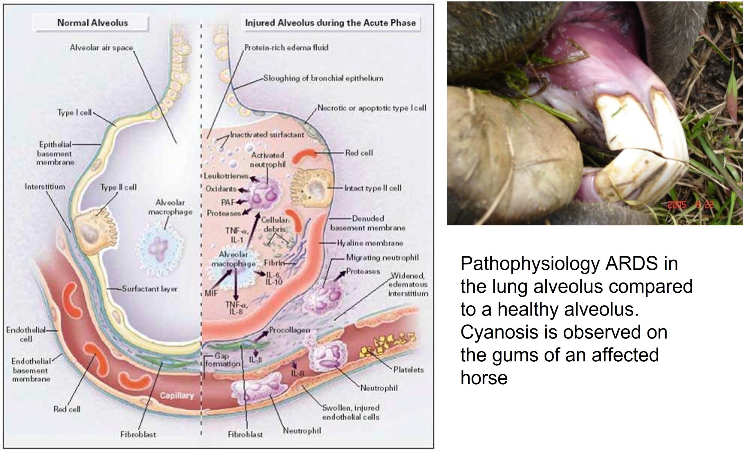 Pathophysiology of ARDS