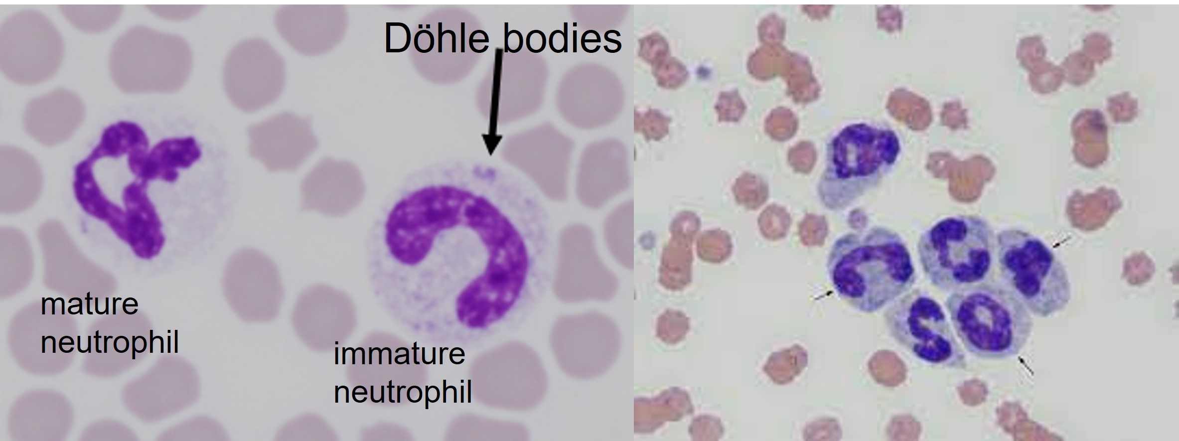 Immature neutrophils with "toxic" changes are release prematurely from the bone marrow when there is a high demanbd for phagocytes i.e. during inflammation. Toxic neutrophils are produced when there is a high demand for neutrophils i.e. inflammation. Toxic changes include the presence basophilic cytoplasm, vacoules within the cytoplasma, less segmentation of the nuclei and giant neutrophils.